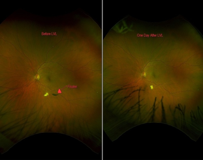 Laser vitreolysis treatment offered by Spindel Eye Associates in Derry and surrounding areas